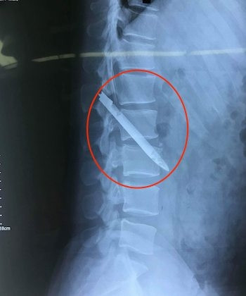 Hình ảnh chup X- quang lúc chưa phẫu thuật. Ảnh: Bệnh viện.