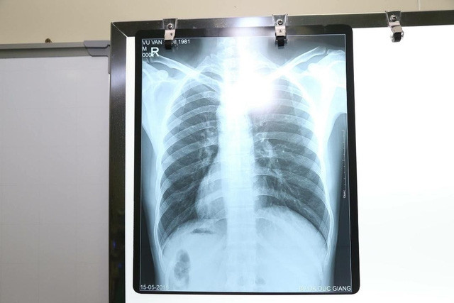 Nam bệnh nhân phủ tạng đảo ngược ở Hà Nội: tim bên phải, gan bên trái - Ảnh 1.
