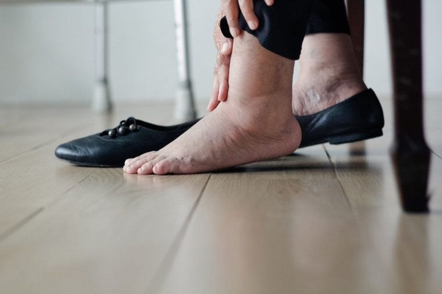Cẳng chân và bàn chân sưng phù: Cẳng chân và bàn chân sưng phù cũng có thể là dấu hiệu của các vấn đề về tim mạch. Khi tim không thể bơm máu hiệu quả, các mạch máu sẽ co lại, đẩy các dịch thể thừa vào các mô, dẫn đến tình trạng sưng phù do tích nước ở bàn chân, cẳng chân và bụng.