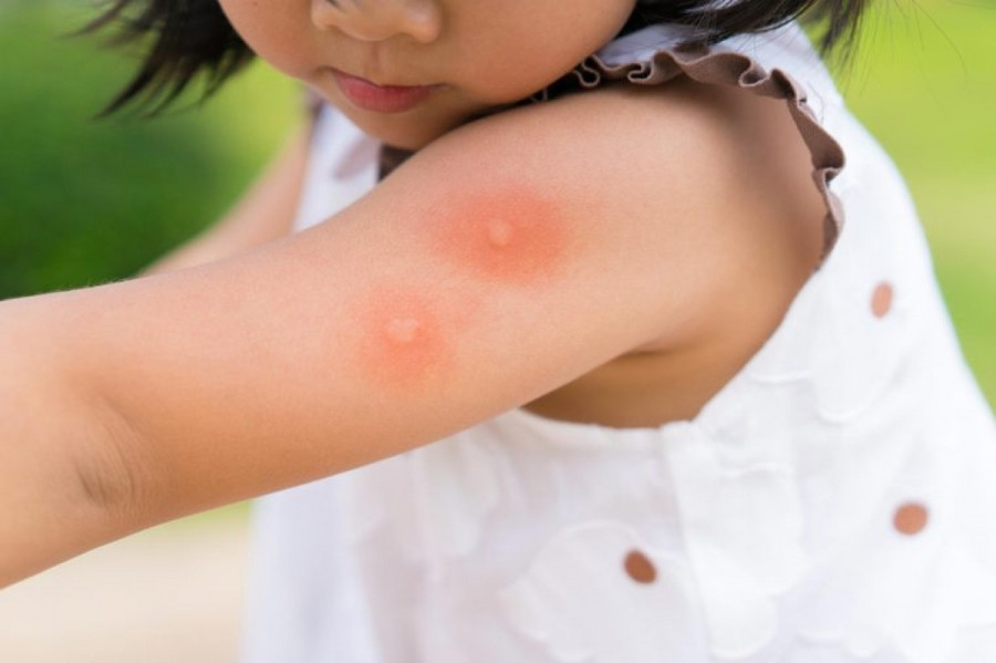 Muỗi: Bản thân vết muỗi cắn không phải là vấn đề lớn, nhưng muỗi lại có thể là trung gian lây truyền một số căn bệnh nguy hiểm như sốt rét, sốt xuất huyết, hay bệnh Zika. Nếu bạn nhận thấy các triệu chứng như sốt cao, đau đầu, mệt mỏi, buồn nôn, nôn mửa, sưng hạch bạch huyết, nổi mẩn đỏ sau khi bị muỗi đốt, hãy đến cơ sở y tế để được điều trị ngay.