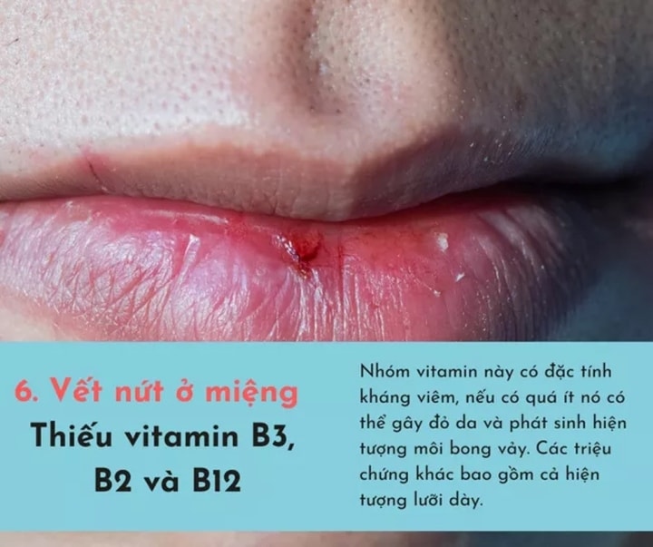 6 dấu hiệu báo động cơ thể thiếu nghiêm trọng vitamin - 6