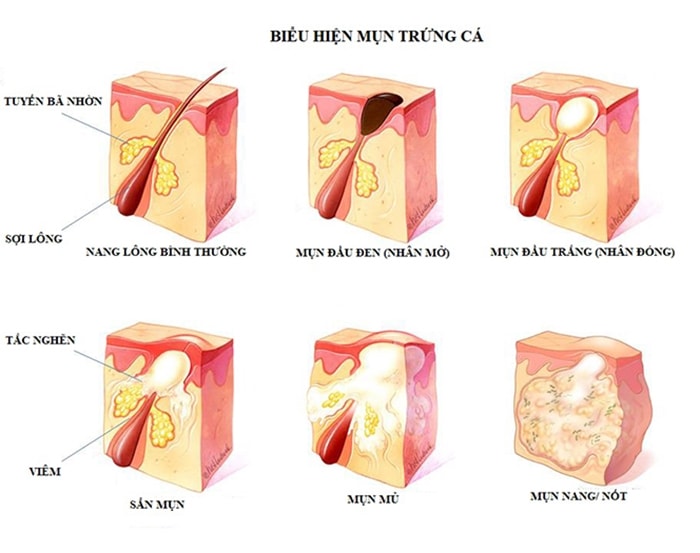 Các loại mụn trứng cá và cách điều trị đúng - Ảnh 1.