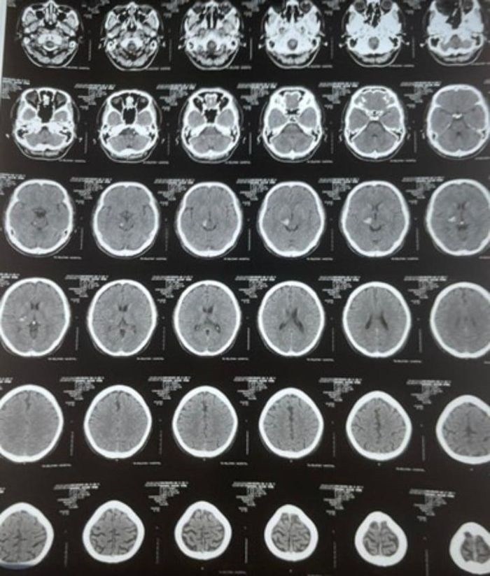 Phim chụp CT của bệnh nhân Nguyễn Văn Anh, 35 tuổi, ngụ quận 8, TP.HCM. (Ảnh BVCC)