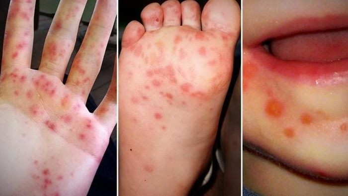 Bệnh tay chân miệng là do virus thuộc nhóm Enterovirus gây nên.