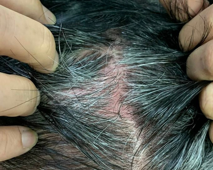 Da đầu ông Nam đỏ rát, ngứa và châm chích sau khi dùng thuốc phủ bạc tóc. Ảnh: Bác sĩ cung cấp