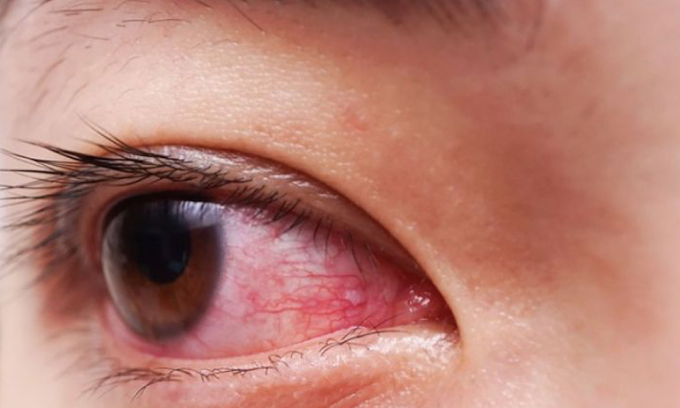 Một bệnh nhi bị đau mắt đỏ. Ảnh:Bệnh viện cung cấp