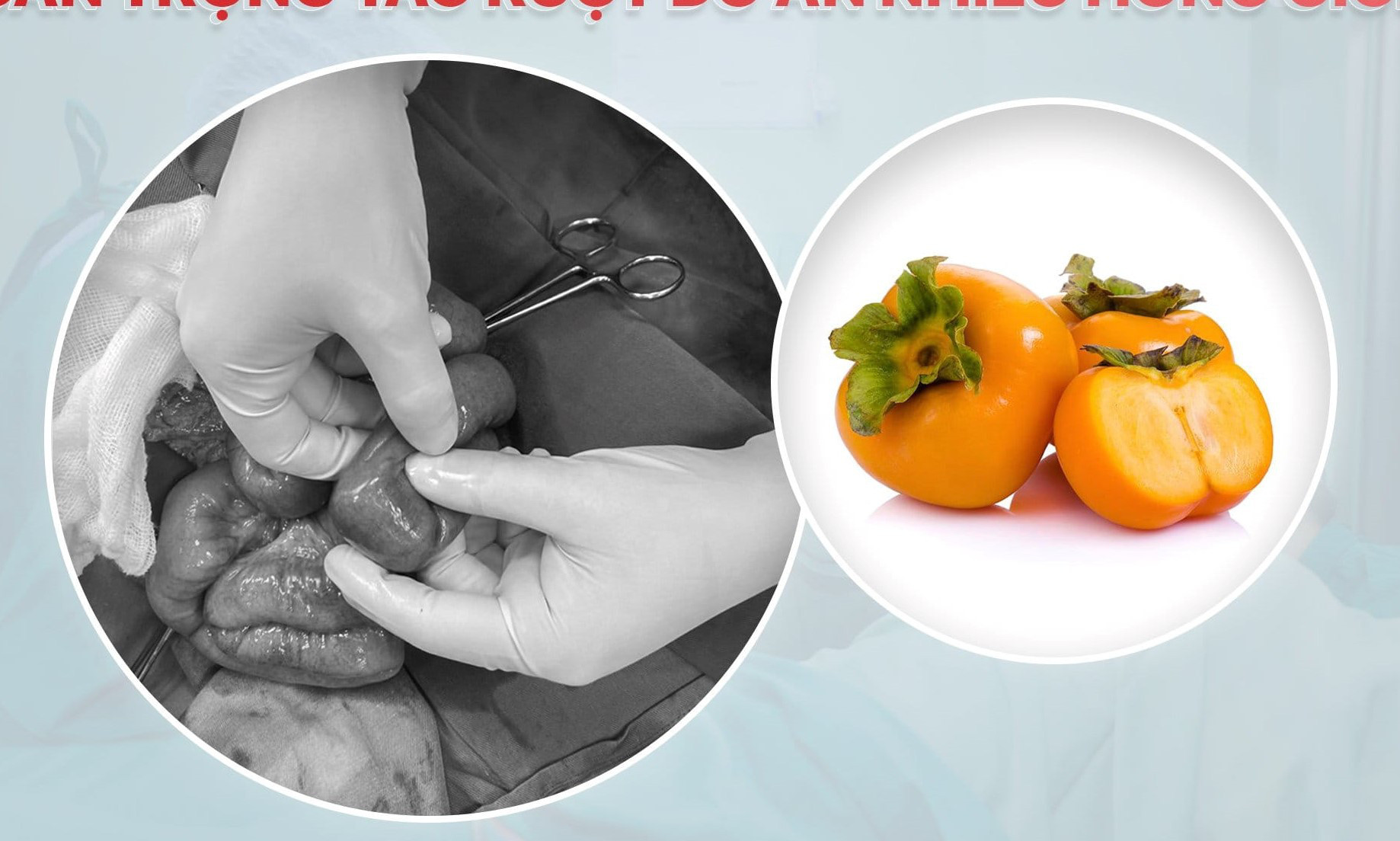 Điều trị cho bệnh nhân tắc ruột do ăn hồng tại Nghệ An - Ảnh: BVCC