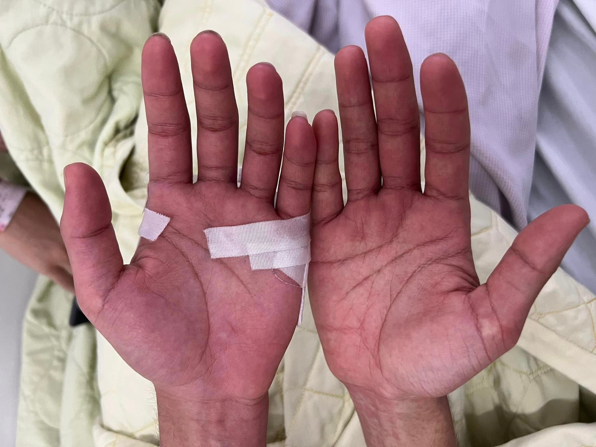 Bệnh nhân bị sốt xuất huyết từ ngày thứ 5-6 trở đi xuất hiện ngứa 2 lòng bàn tay, bàn chân. (Ảnh: BSCC)