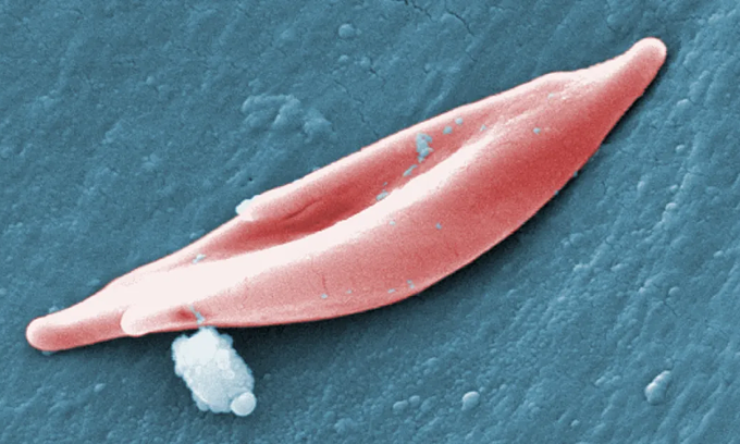 Một tế bào hồng cầu hình liềm. Ảnh: CDC
