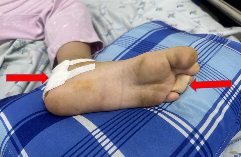 Trẻ bị giập nát phần gót chân và ngón chân thứ 3 và 4 bên trái do cuốn vào căm bánh xe - Ảnh: Bác sĩ cung cấp