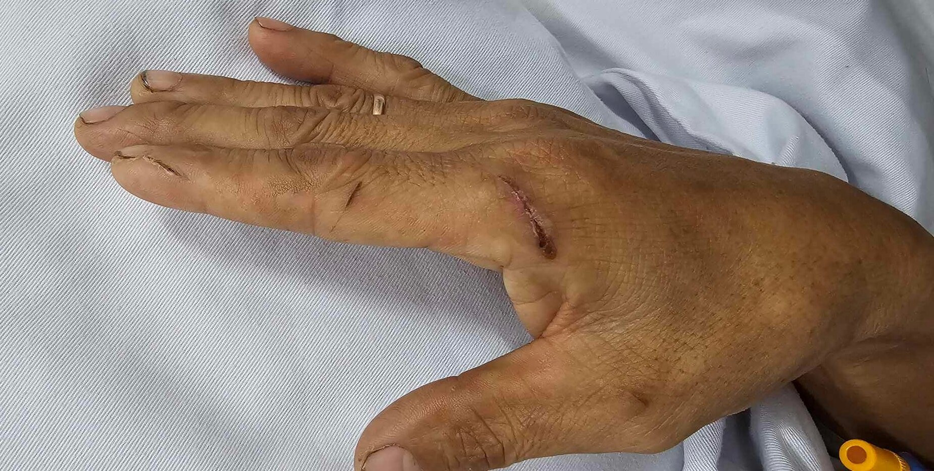 Bàn tay bị đứt của người đàn ông. (Ảnh: BSCC)