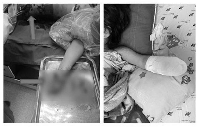 Bé gái 5 tuổi bị mất một bàn tay trái khi nhặt viên pháo đại sau khi nhà hàng xóm bắn pháo hoa - Ảnh: Bệnh viện cung cấp 