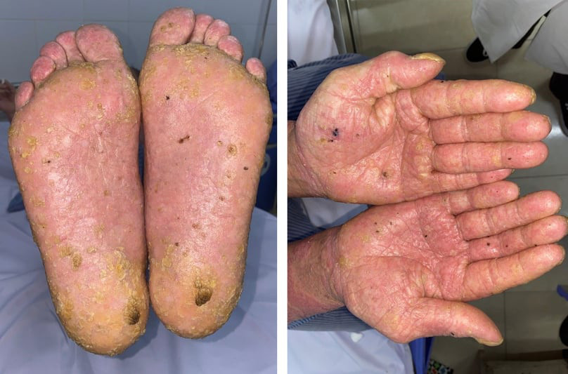 Tổn thương dày sừng từng điểm lòng bàn tay, bàn chân ở bệnh nhân nhiễm độc asen - Ảnh: BVCC