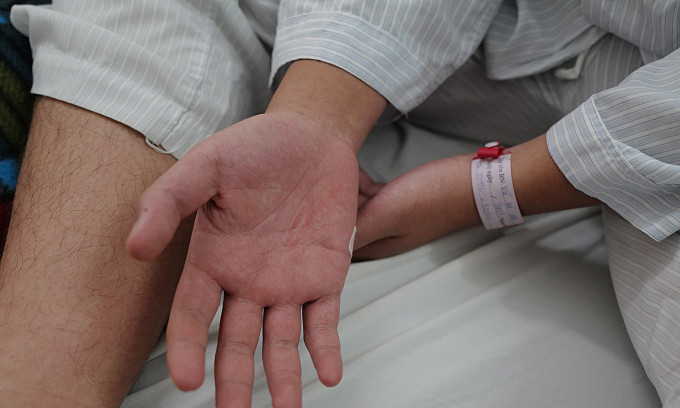 Bệnh nhân sốt xuất huyết với bàn tay đỏ au, điều trị tại Bệnh viện Bạch Mai. Ảnh:Ngọc Thành