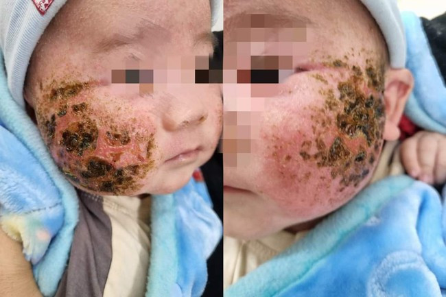 Tự đắp lá cây chữa viêm da, bé trai 4 tháng tuổi bị loét má - Ảnh 1.