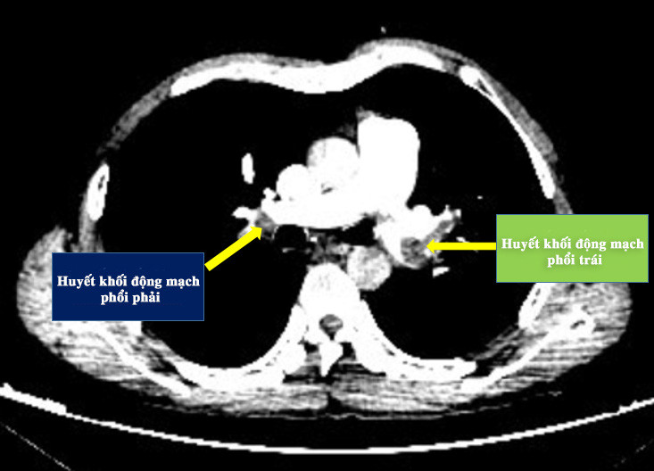 Hình ảnh huyết khối động mạch phổi cả hai bên của bệnh nhân B. - Ảnh: BVCC