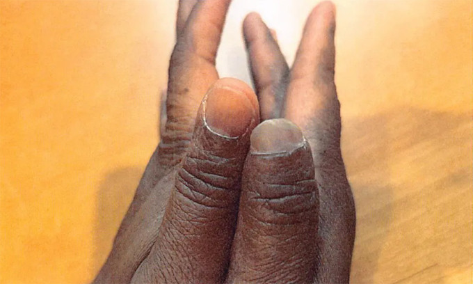 Boateng cho thấy phần đầu ngón cái của bàn tay phải đã mất sau tai nạn năm 2016. Ảnh: New York Post