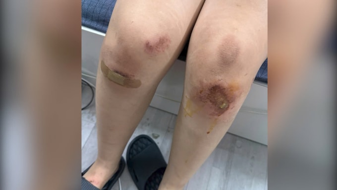 Đầu gối của Hương bị trầy xước do phải quỳ và bị kéo lê. Ảnh: Nhân vật cung cấp