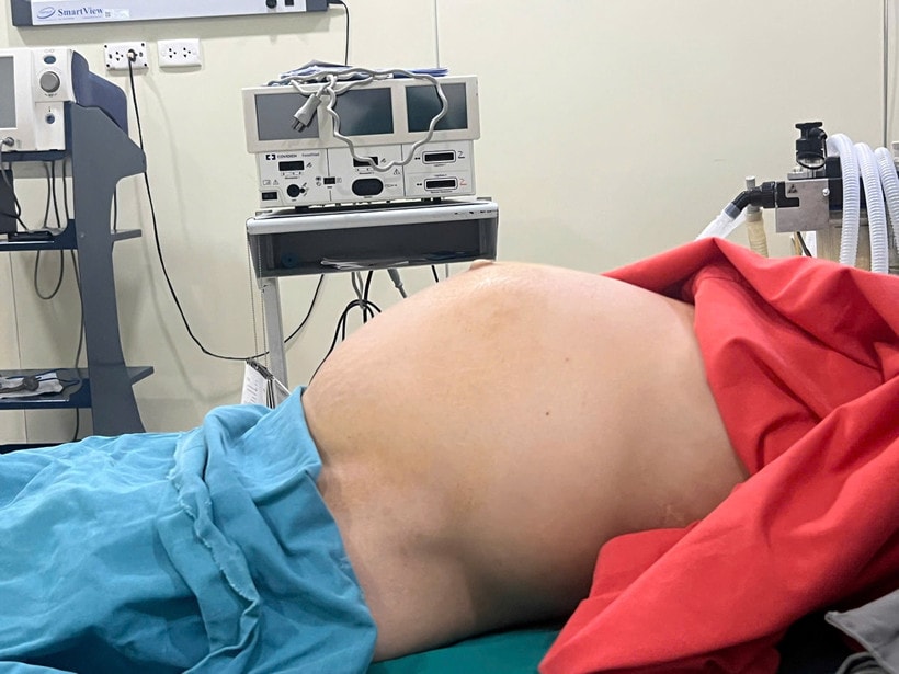 Khi bệnh nhân nhập viện, khối u đã phát triển rất to, tương đương thai 9 tháng. (Ảnh: PV/Vietnam+)