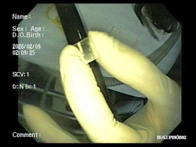 Los médicos extrajeron el trozo de plástico del esófago del niño.