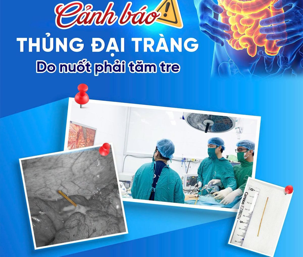 Người đàn ông ở Vĩnh Bảo thủng ruột vì ngậm tăm tre sau bữa ăn