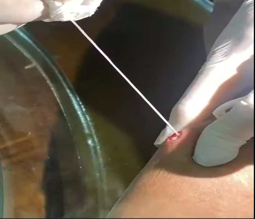Đoạn giun rồng kéo ra từ cánh tay anh T. dài khoảng 10-15cm do người nhà tự nặn. (Ảnh: PV/Vietnam+)
