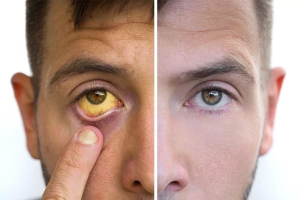 Triệu chứng ung thư bộc lộ qua đôi mắt - 1