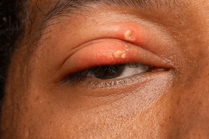 Zona ở mắt có thể gây ra biến chứng nguy hiểm.