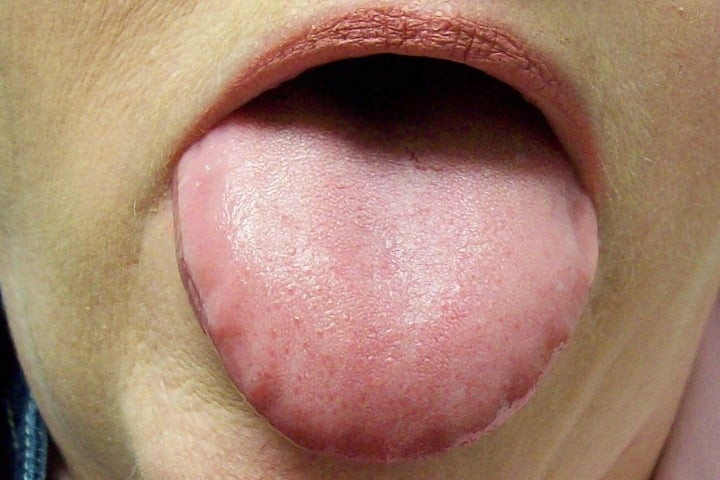 5 dấu hiệu ở lưỡi cảnh báo bệnh ung thư - 1