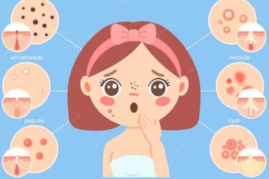 Số trẻ dậy thì sớm ngày càng tăng