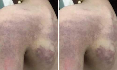 Tạm dừng đứng lớp cô giáo đánh học sinh lớp 3 bầm tím lưng