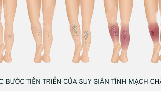 Vì sao phụ nữ hay bị giãn tĩnh mạch chi?