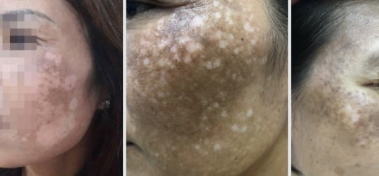 Mặt loang lổ như pháo hoa vì đắp "thần dược" trị nám
