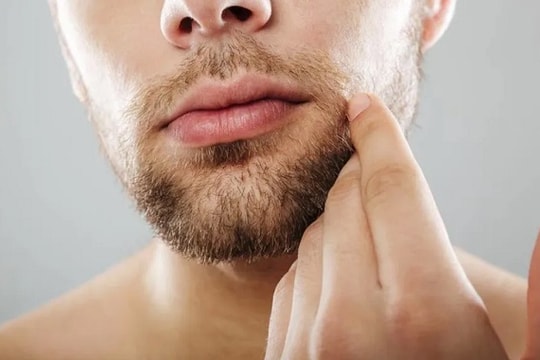 Giải quyết nỗi lo gàu râu cho nam giới