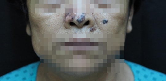 Bệnh viện Da liễu phát cảnh báo về ung thư da ở người trên 60 tuổi