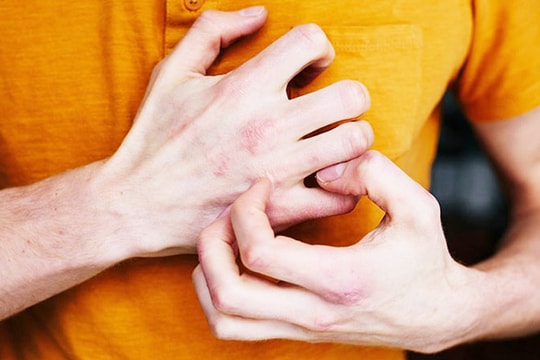 Cách hạn chế viêm da mùa lạnh