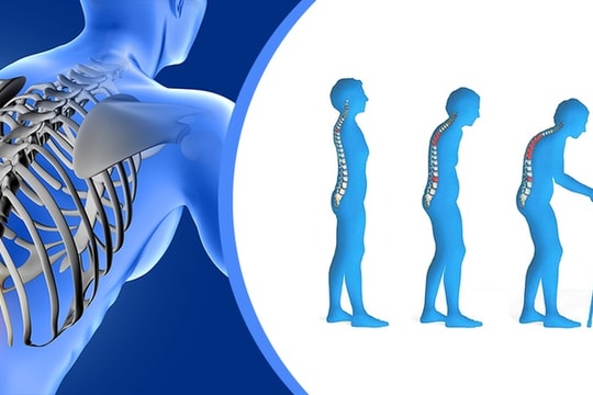 Người Việt lười vận động, làm gia tăng nguy cơ loãng xương