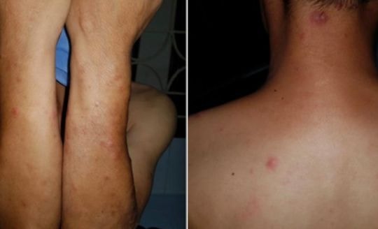 Nhiều người ở đô thị vẫn mắc bệnh phong