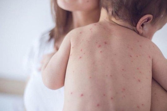 Dự phòng bệnh sởi cho trẻ trong mùa đông xuân