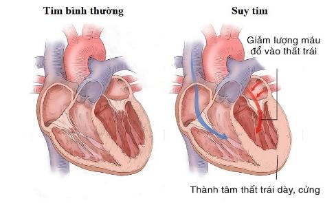 Lối sống lành mạnh giúp ngăn ngừa suy tim