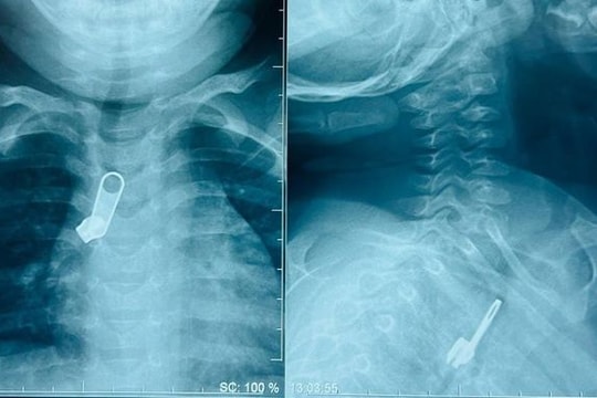 Bé trai 15 tháng tuổi bị kẹt móc khóa kéo trong đường thở