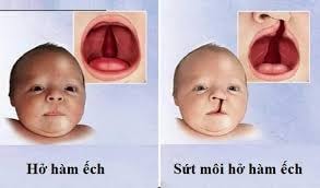 Phẫu thuật miễn phí dị tật cho trẻ em