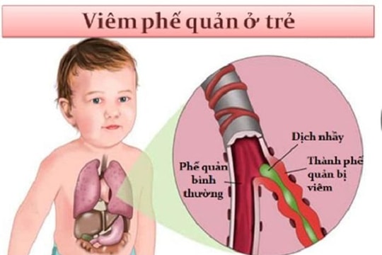 Chăm sóc trẻ viêm phế quản đúng cách để giúp trẻ chóng hồi phục