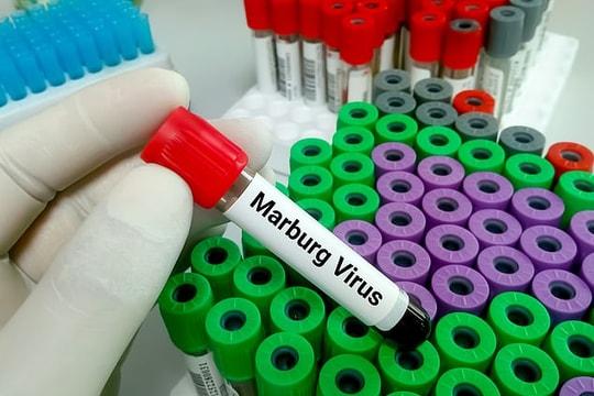 Bùng phát virus Marburg gây tử vong cao ở Tanzania