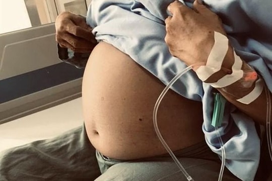 Bác sỹ Bệnh viện K bóc tách khối u nặng gần 10kg cho nữ bệnh nhân
