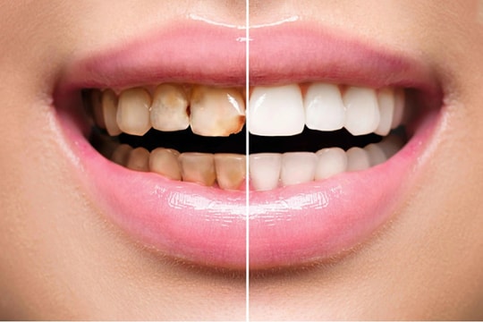 5 cách tránh rụng răng sớm