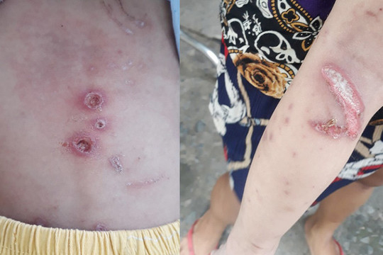 Xác minh vụ bé trai hơn 1 tuổi bị thương khắp người ở Hóc Môn
