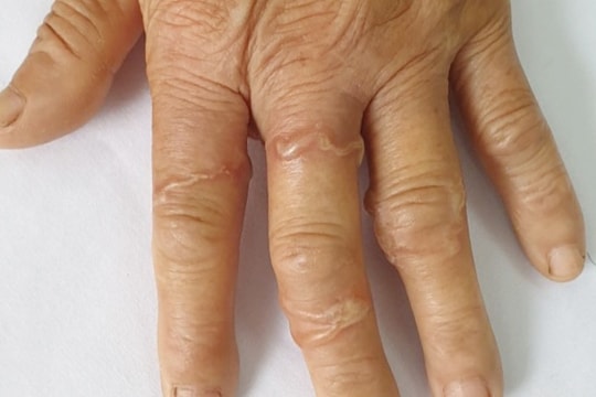 Tiêu chảy 10 năm mới biết nhiễm giun đũa chó mèo