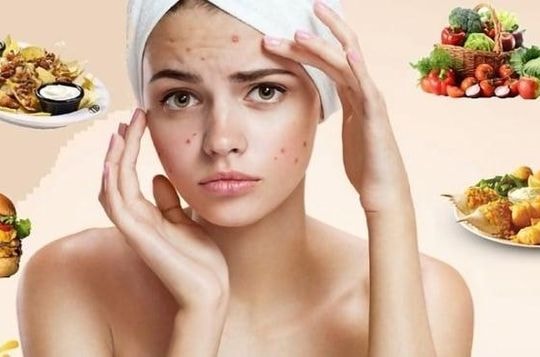 Mùa hè ăn gì để da khỏe đẹp, tránh nổi mụn?