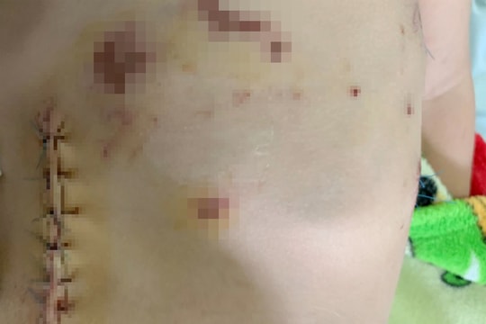 Bé gái 3 tuổi bị chó cắn lòi ruột, chấn thương nặng